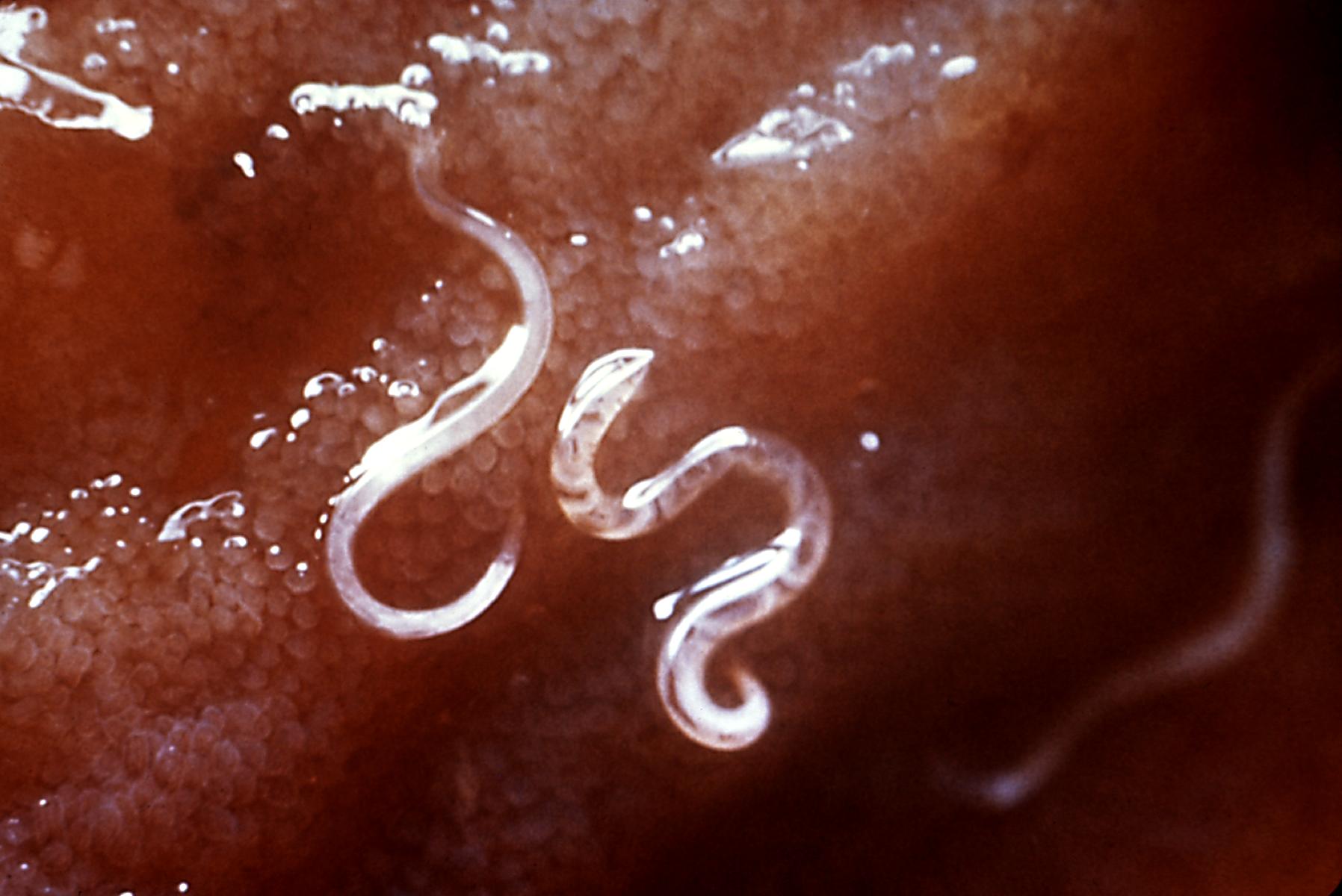 Imagem de referência de ancilostomíase, descrito nos dados abertos como doença humana