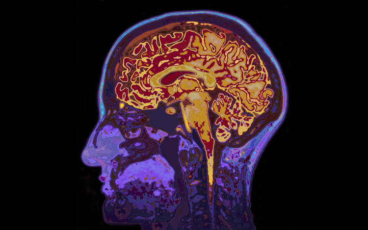 MRI Image Of Head Showing Brain