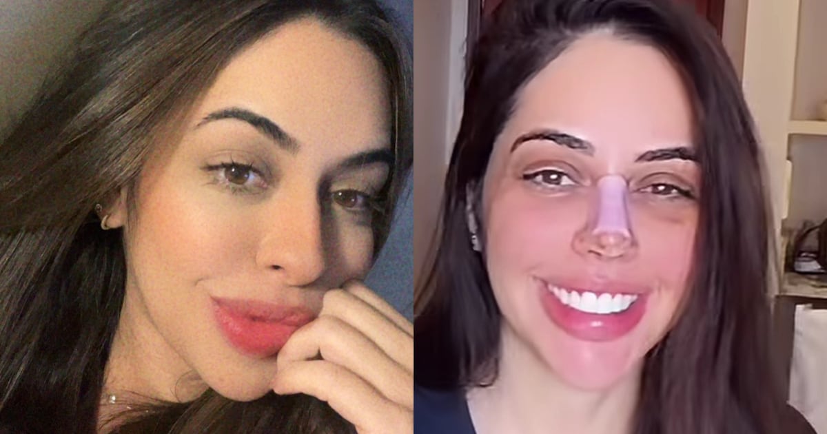 Namorada de Giovani faz plástica no nariz após dois meses com o cantor; veja o antes e o depois