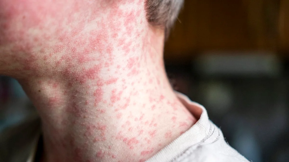 São Paulo tem 40 casos de sarampo; 36 deles são na capital