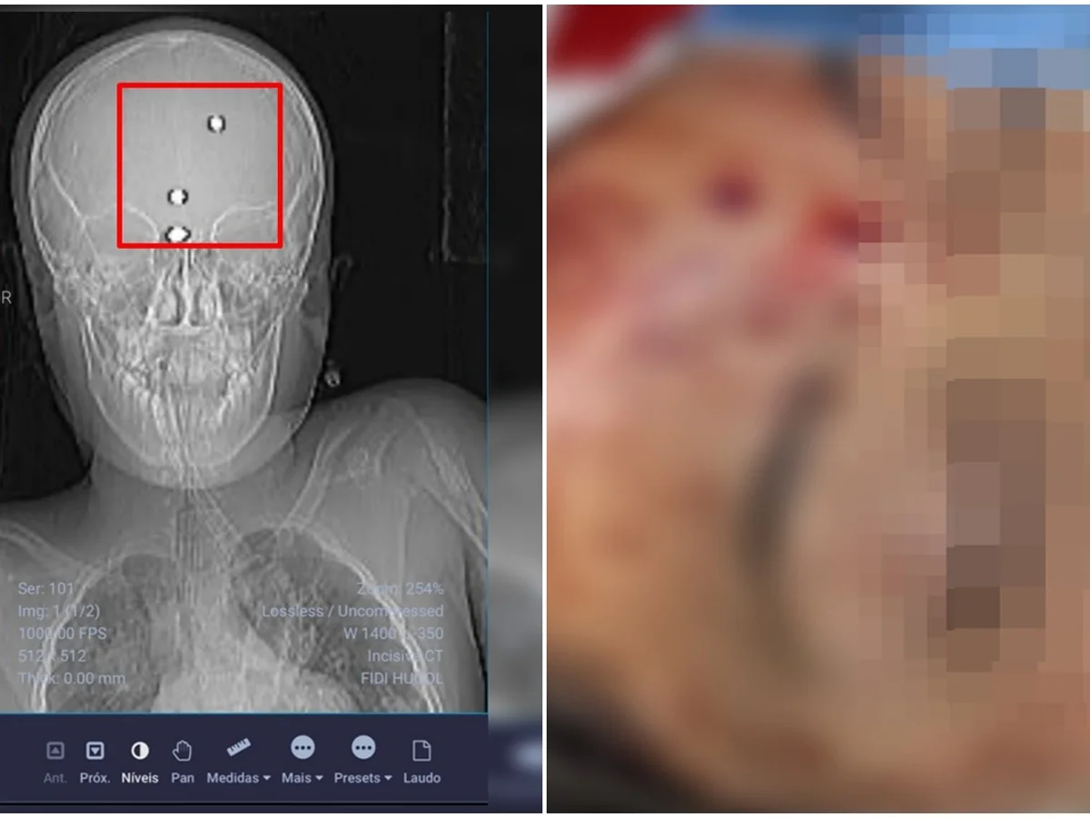 GO: menino baleado com arma de chumbinho deixa UTI após semanas internado
