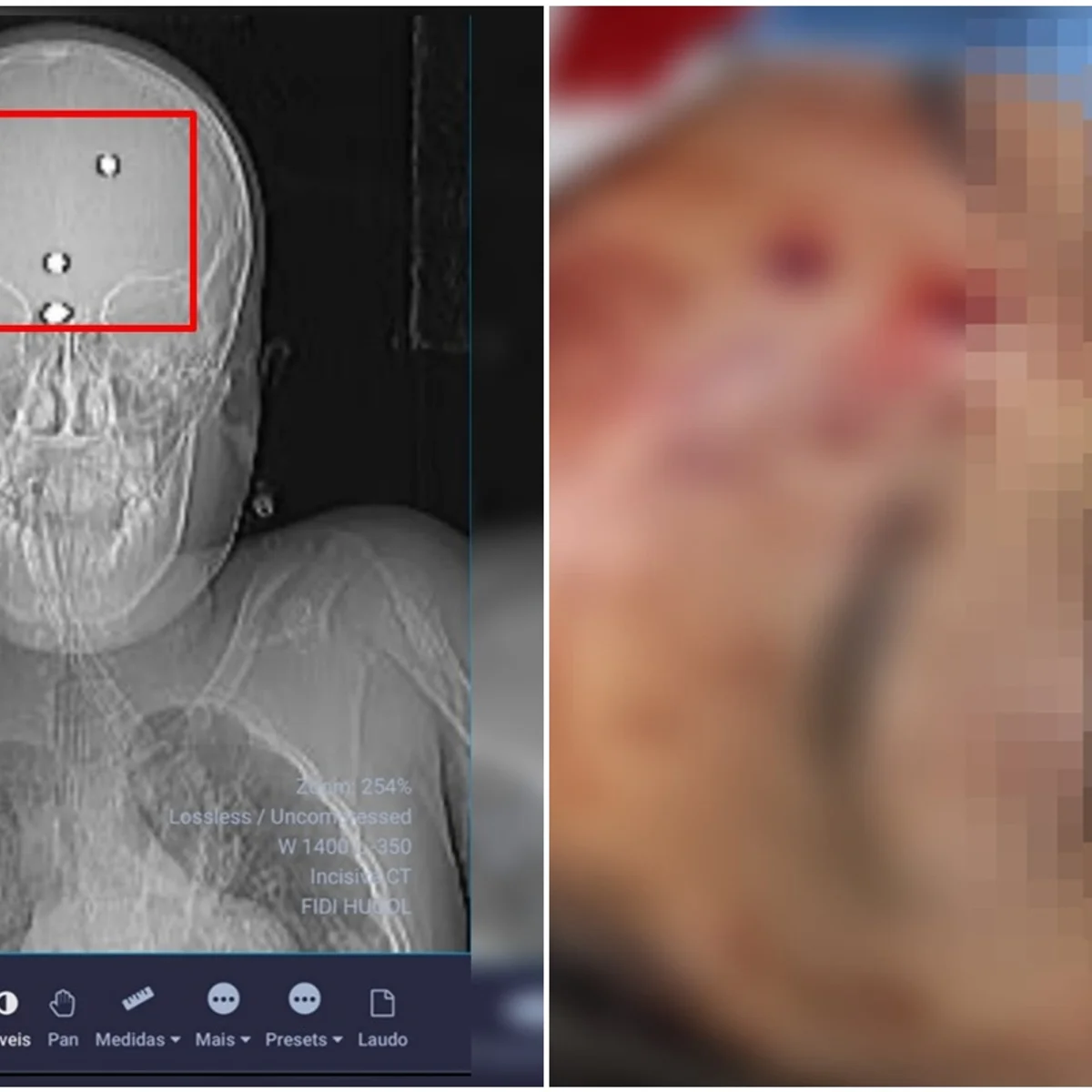 GO: menino baleado com arma de chumbinho deixa UTI após semanas internado