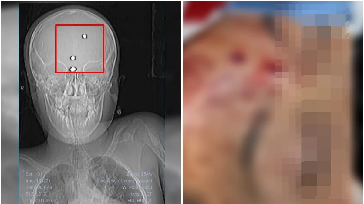 GO: menino baleado com arma de chumbinho deixa UTI após semanas internado