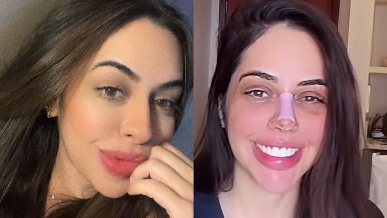 Namorada de Giovani faz plástica no nariz após dois meses com o cantor; veja o antes e o depois